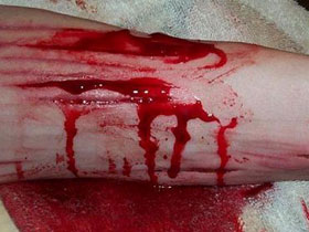 Вскрытые вены. Фото: generalnet.ru Вскрытые вены. Фото: generalnet.ru