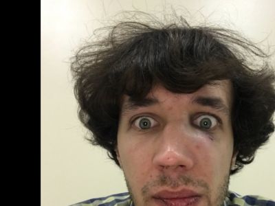 Избитый кандидат в депутаты Георгий Малец. Фото: twitter.com/martin_camera Избитый кандидат в депутаты Георгий Малец. Фото: twitter.com/martin_camera